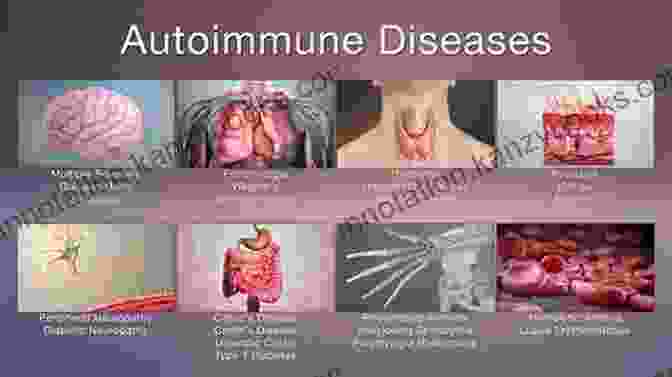 Hashimoto's Thyroiditis A Partner S Guide To Thyroid Autoimmune Disease: Understand Her Struggle How To Help